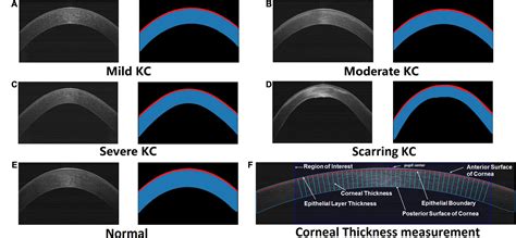 how to increase corneal thickness